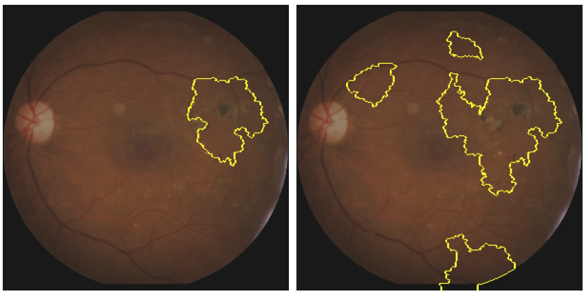 Imagerie médicale : Méthodes d'explicabilité pour la classification d'images